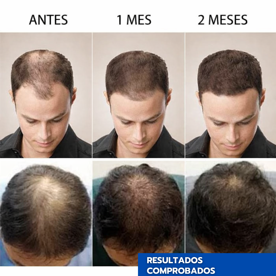 ReGrowX™ | Crema Capilar con Minoxidil 5% para Crecimiento, Grosor y Anti Caída